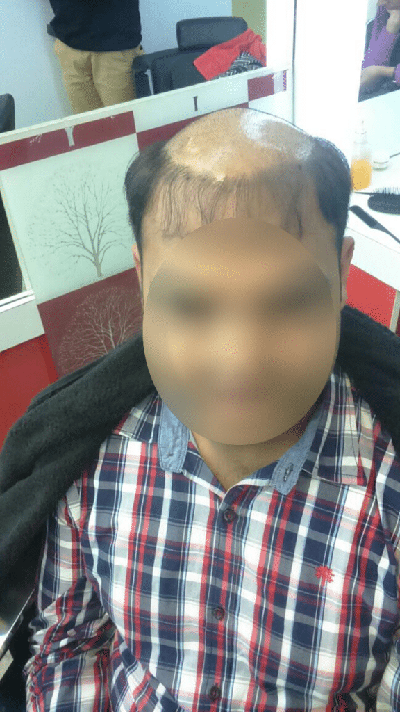 Hair Bonding Treatment NonSurgical Hair Restoration‎ in Noida