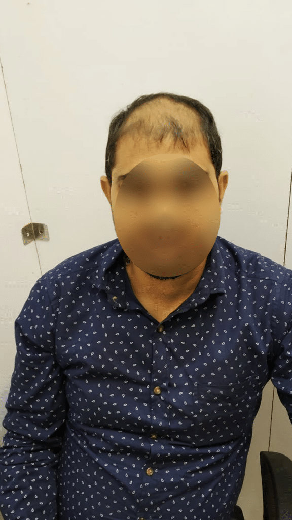 Hair Bonding Treatment NonSurgical Hair Restoration‎ in Noida