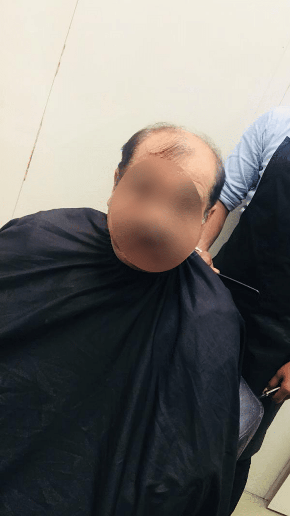 Hair Bonding Treatment NonSurgical Hair Restoration‎ in Noida