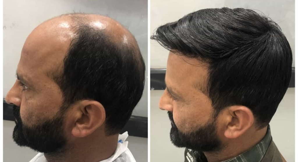 5 Signs That Say It’s Time To Replace Your Hair Patch