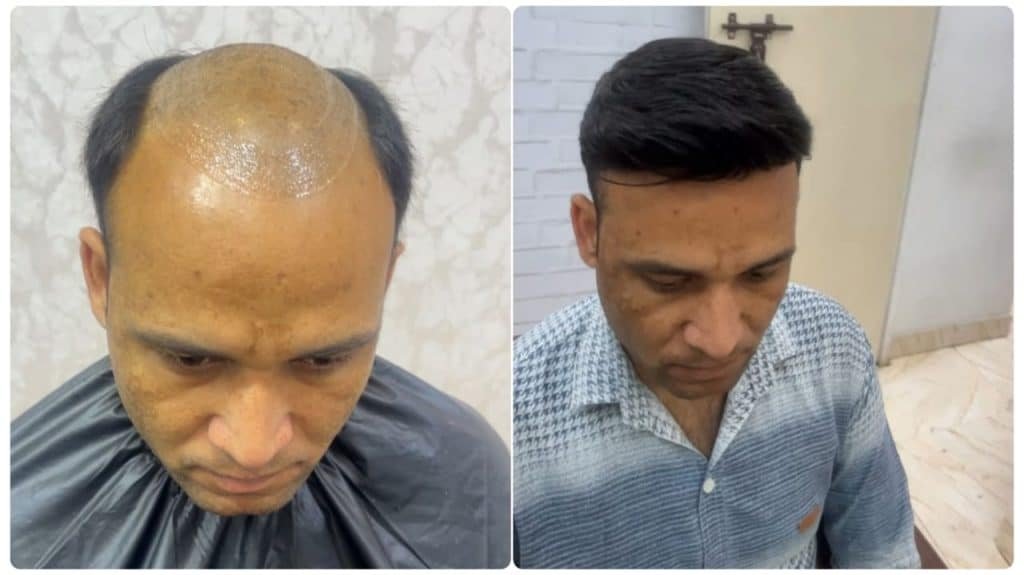 Hair Patch Service Near Me – Restore Your Hair Instantly