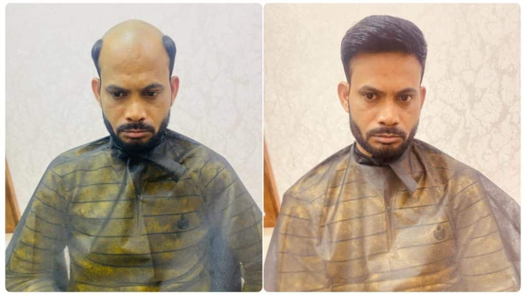 Hair Patch in Delhi: Natural, Non-Surgical Hair Restoration