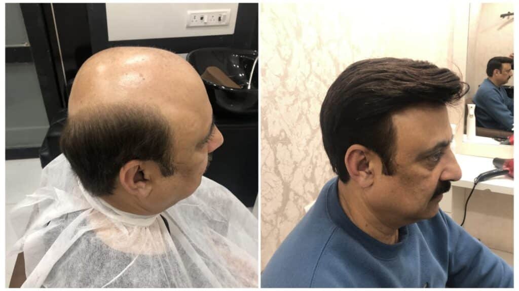 Exploring Hair Patch Solutions in Sector 44, Chandigarh