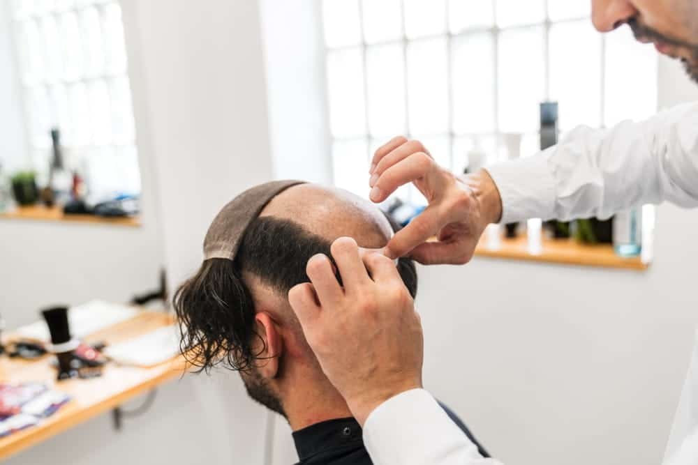 Best Hair Patch in Sector 15 Noida – Get a Natural Look with Advance Hair Clinic